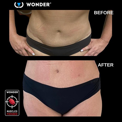 Results of Wonder treatment